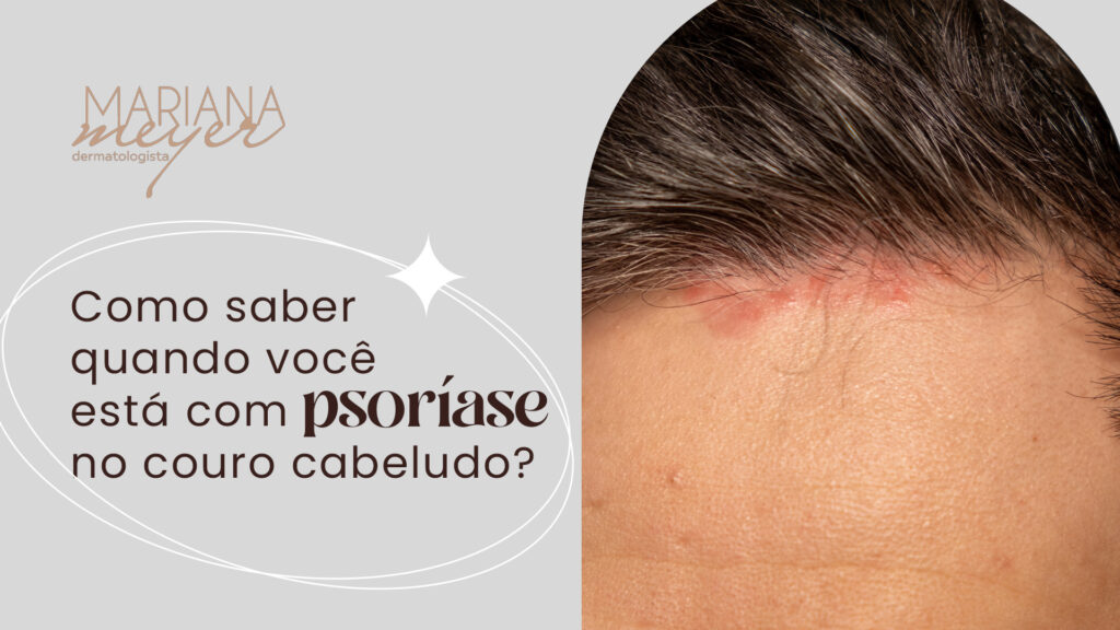 Homem coom ferida no topo da cabeça, aparecendo abaixo do cabelo, próximo à testa, e o seguinte texto: Como saber quando você está com psoríase no couro cabeludo?