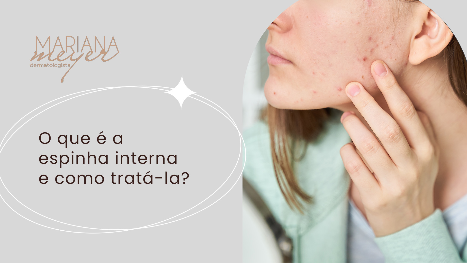 Mulher se olhando no espelho e tocando em uma espinha, com o seguinte texto ao lado: O que é a espinha interna e como tratá-la?