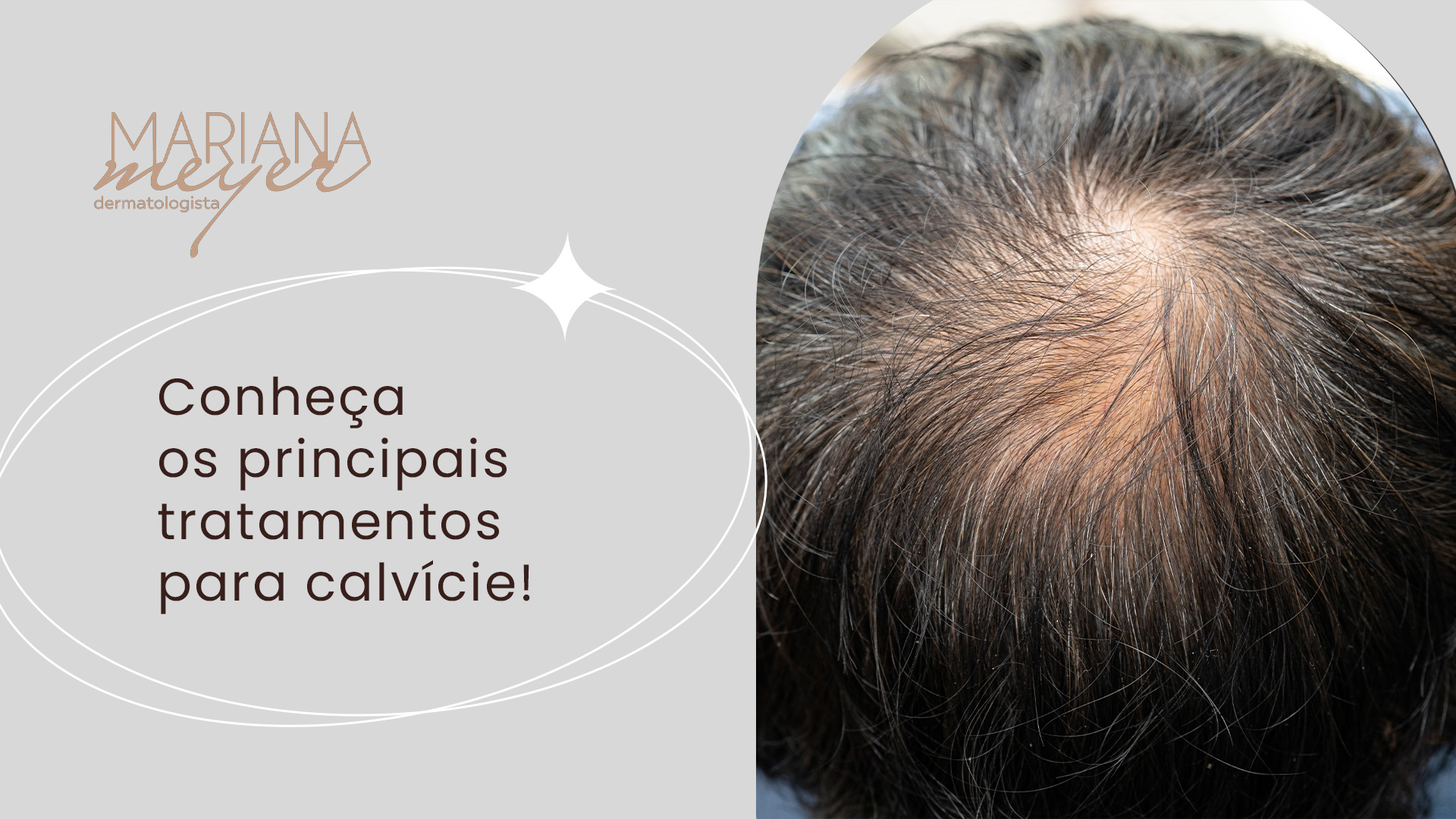 Homem com grande falha no cabelo, na parte de cima da cabeça, e o seguinte texto: Conheça os principais tratamentos para calvície!