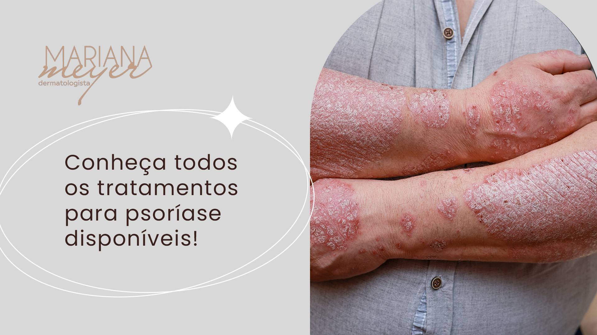 Homem com feridas de psoríase em ambos os braços e o seguinte texto: Conheça todos os tratamentos para psoríase disponíveis!