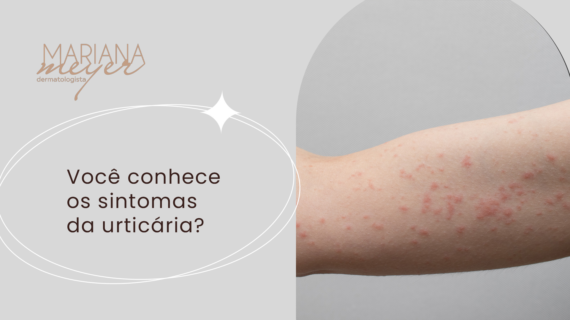 Braço de pessoa com feridas vermelhas e o seguinte texto: Você conhece os sintomas da urticária?