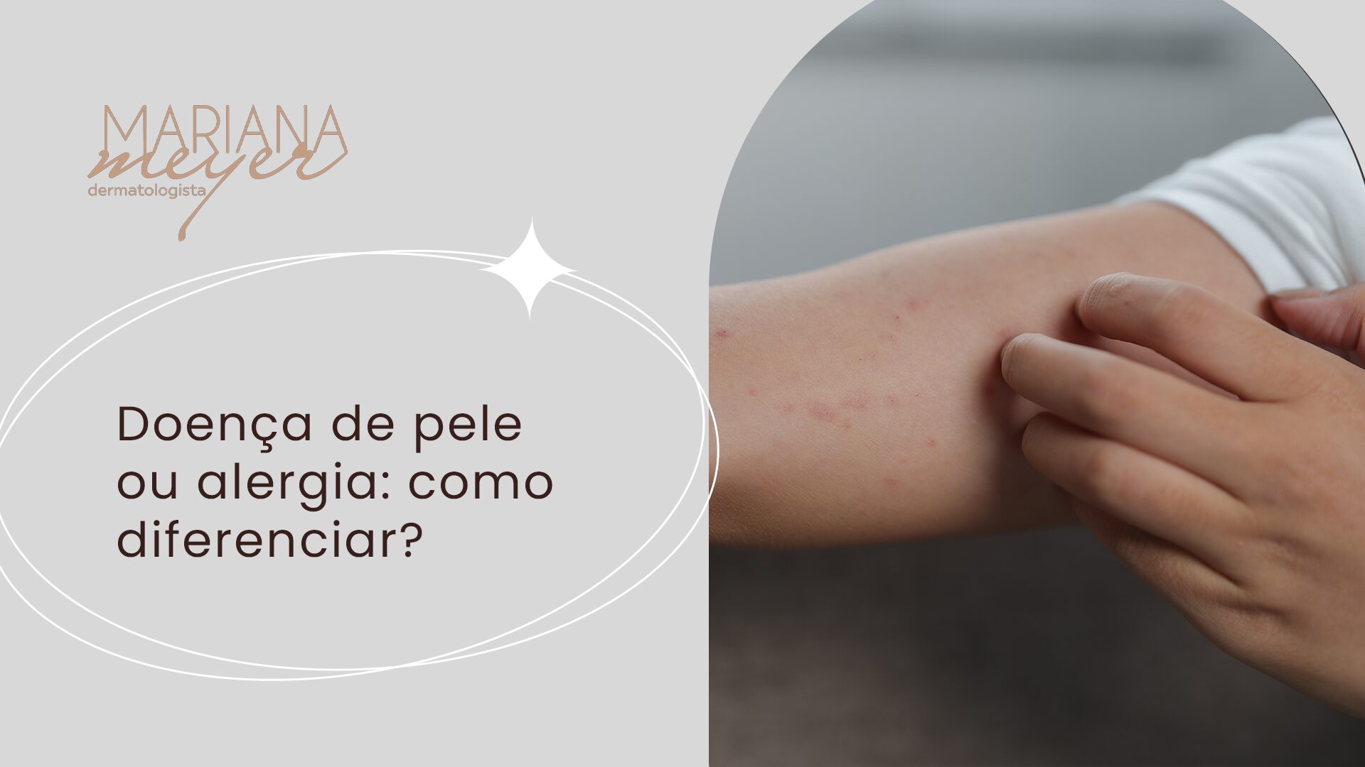 Homem caucasiano coçando o braço e o seguinte texto: Doença de pele ou alergia: como diferenciar?