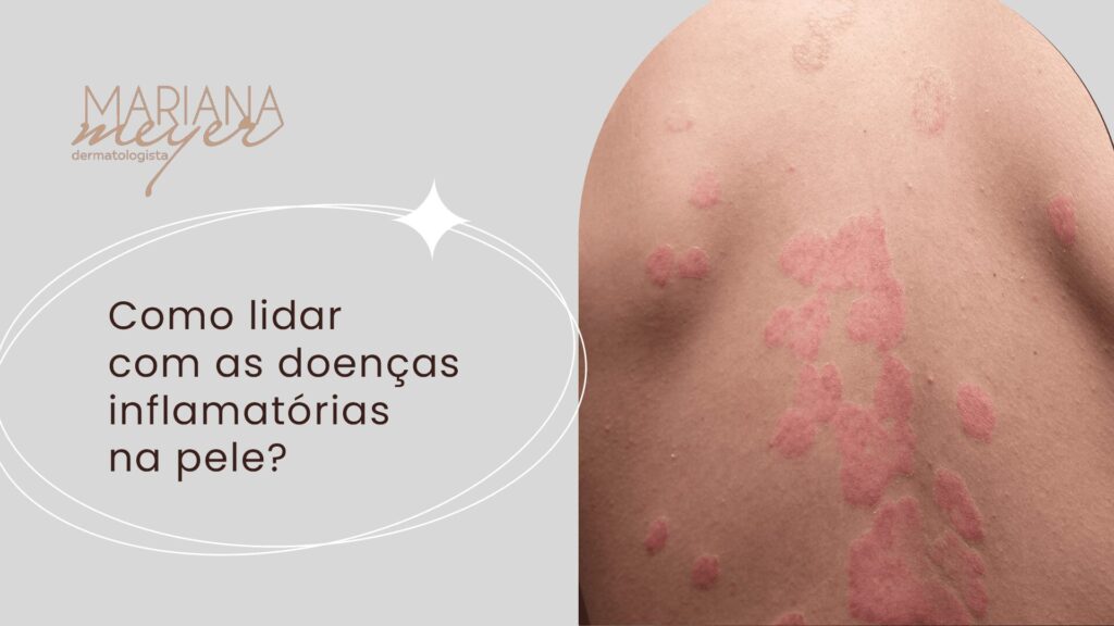 Costas de homeem repletas de brotoejas vermelhas e o seguinte texto: Como lidar com as doenças inflamatórias na pele?