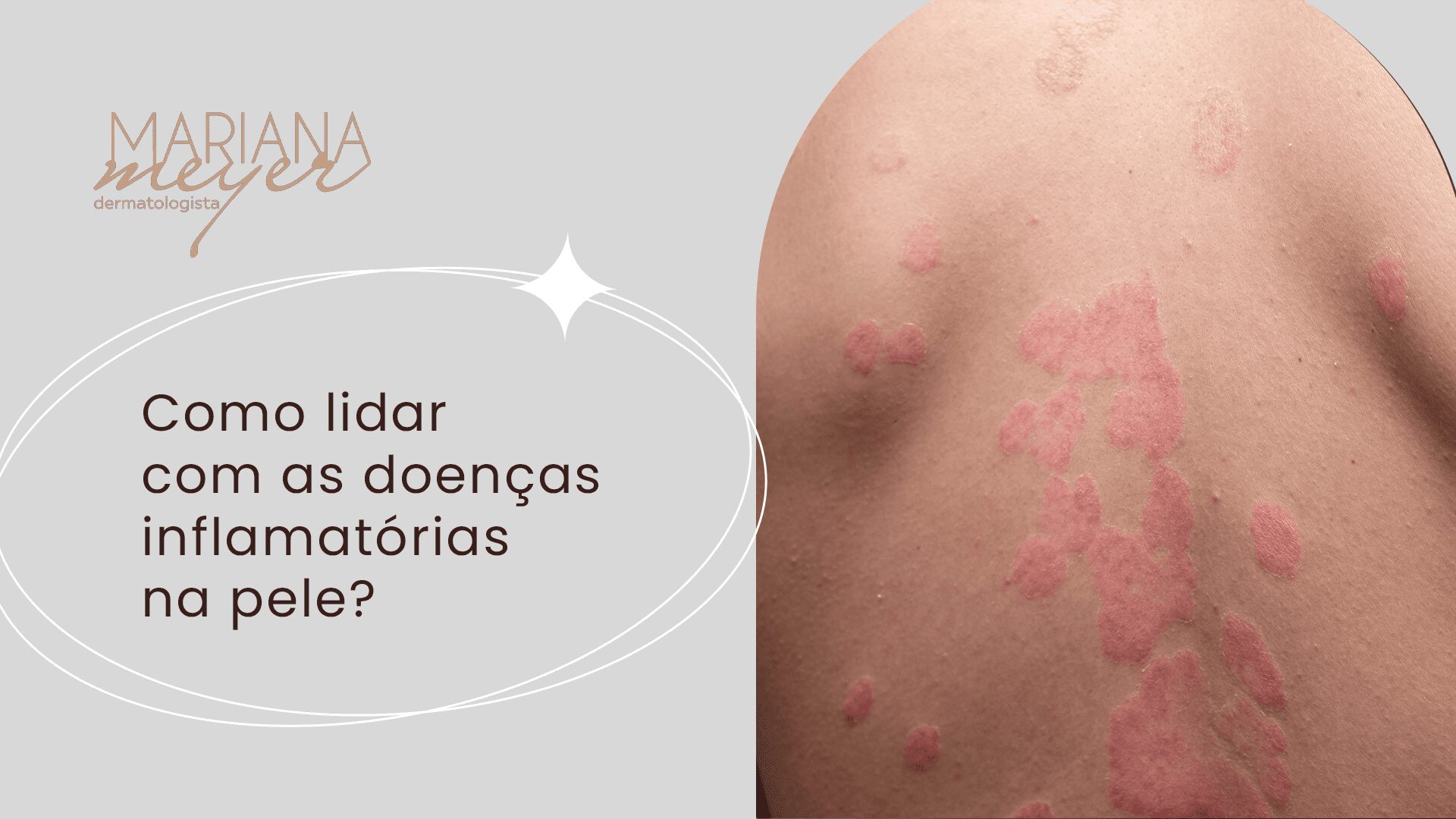 Costas de homeem repletas de brotoejas vermelhas e o seguinte texto: Como lidar com as doenças inflamatórias na pele?