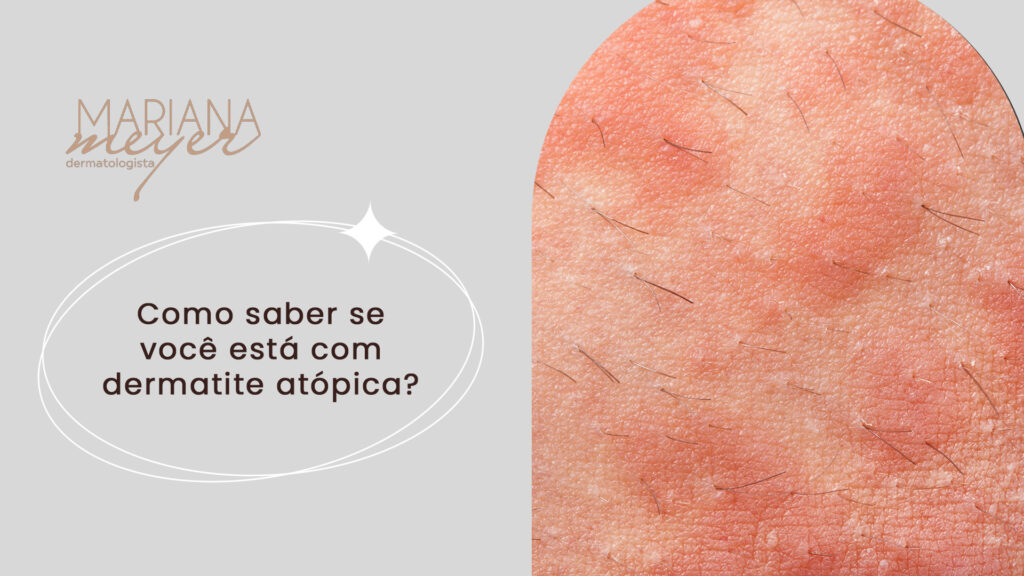 Pessoa com manchas vermelhas na pele e o seguinte texto: Como saber se você está com dermatite atópica?