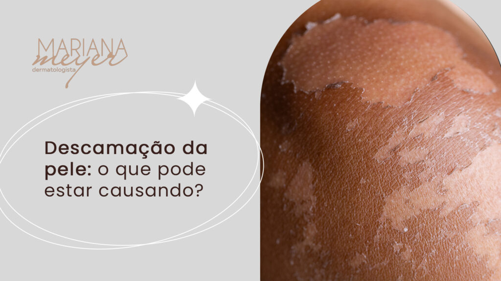Pele descascada e o seguinte texto: Descamação da pele: o que pode estar causando?