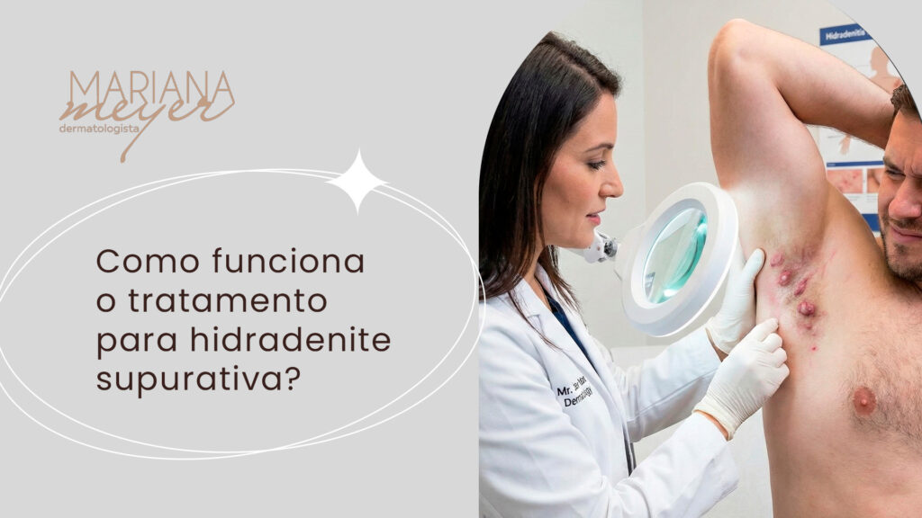 Homem mostrando axila com sintomas de hidradenite para dermatologista, que analisa o quadro e o seguinte texto ao lado: Como funciona o tratamento para hidradenite supurativa?
