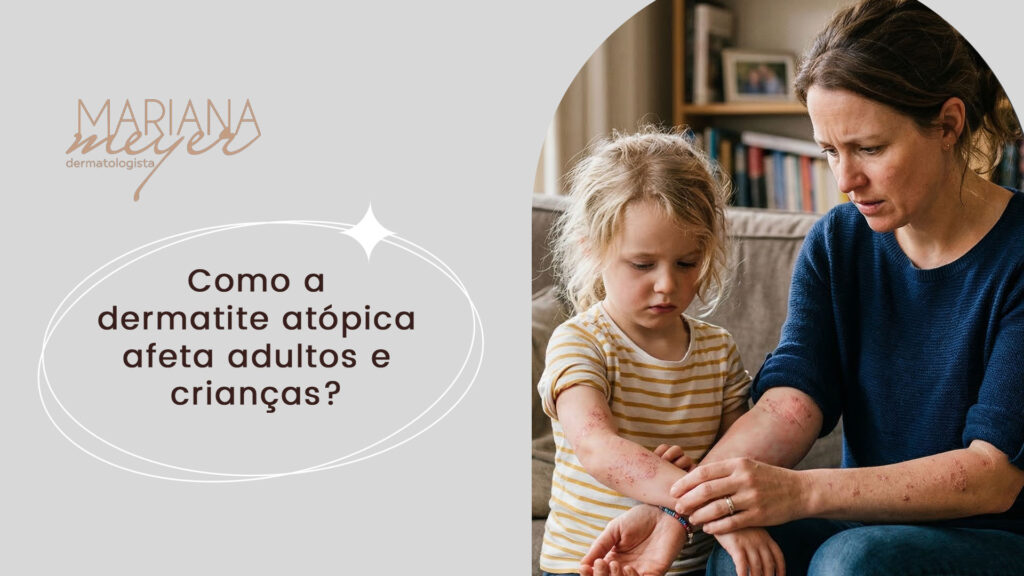 Mãe e filha preocupada, olhando preocupadas o braço, com feridas de dermatite ao longo do corpo e o seguinte texto ao lado: Como a dermatite atópica afeta adultos e crianças?
