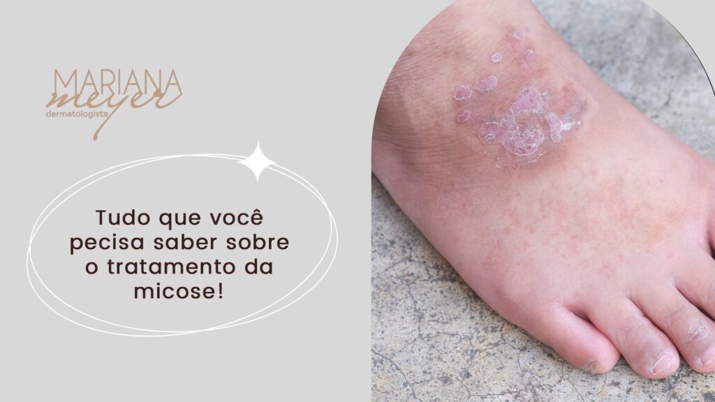 Pé com infecção causada por fungo e o seguinte texto: Tudo que você pecisa saber sobre o tratamento da micose!