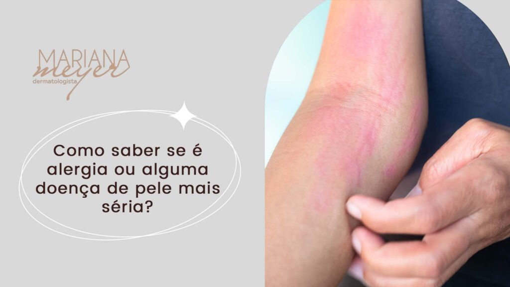Pessoa coçando o braço com manchas rosadas e o seguinte texto: Como saber se é alergia ou alguma doença de pele mais série?