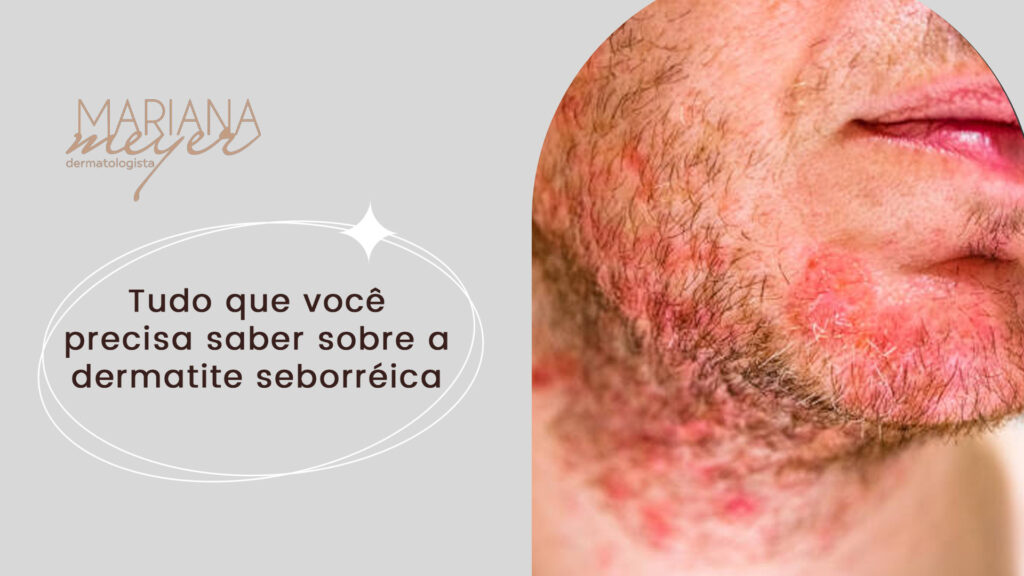 Pessoa com feriadas vermelhas no rosto e no pescoço e o seguinte texto: Tudo que você precisa saber sobre a dermatite seborréica