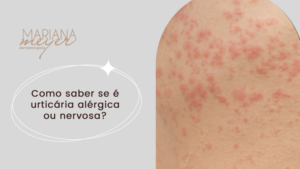 Pessoa com brotoejas na pele e o seguinte texto: Como saber se é urticária alérgica ou nervosa?