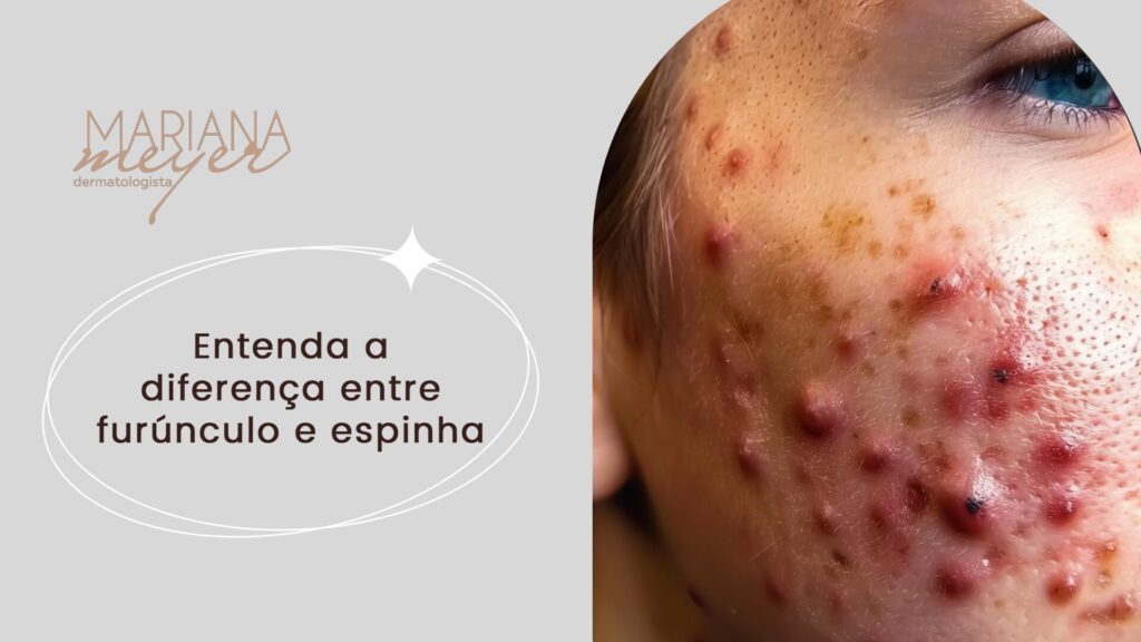 Pessoa com várias feridas vermelhas com pus no rosto e o seguinte texto: Entenda a diferença entre furúnculo e espinha