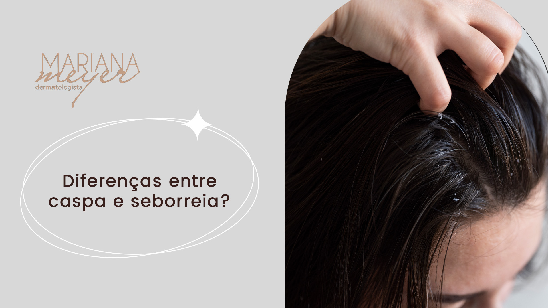 Mulher passando mão no cabelo e revelando pedaços de pele brancos, com o seguinte texto ao lado: Diferenças entre caspa e seborreia?