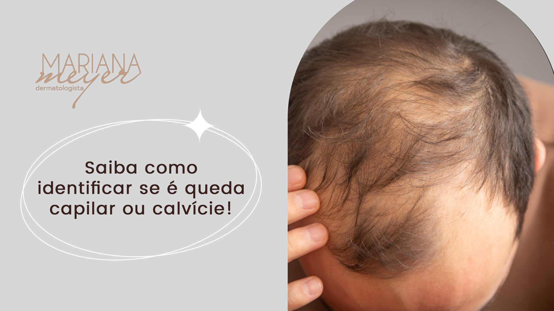 Câmera mostrando por um ângulo de cima um homem com cabelo cheio de falhas e o seguinte texto: Saiba como identificar se é queda capilar ou calvície!